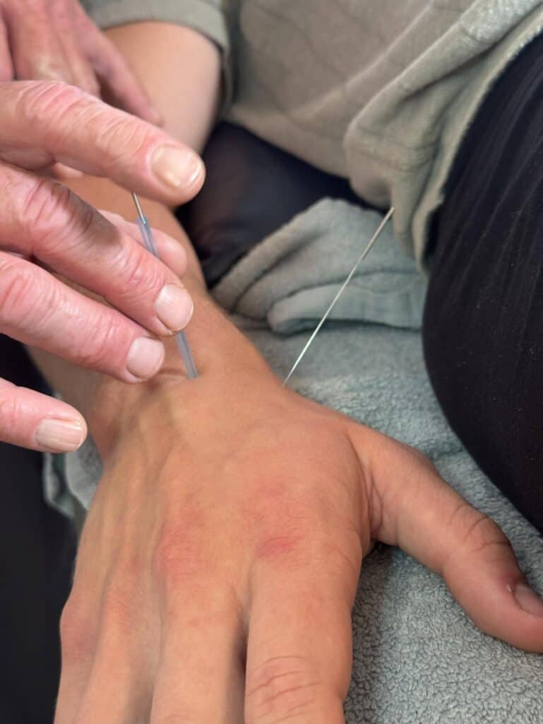 Nærbillede af akupunkturnål isat ved håndens tommelfinger.